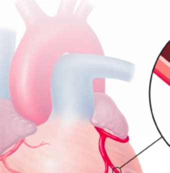 In caso di pericardite costrittiva (una complicanza della pericardite acuta) può mostrare anche gli esiti della cura dipendono dalla causa sottostante: Pericardite: cause, sintomi e cura - Vivere al Meglio