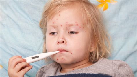 Bintik merah dbd pada beberapa kasus sulit dibedakan dengan penyakit campak. Petanda Baby Demam Campak - Blog Petua