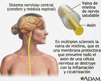 La esclerosis múltiple (em) es una enfermedad autoinmune que hasta el momento no tiene cura. Enfermeria: Esclerosis Multiple: Que es