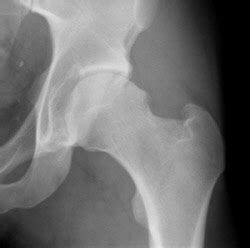 Sports Hip Surgery, Mr Ganapathi, specialist hip surgeon ...
