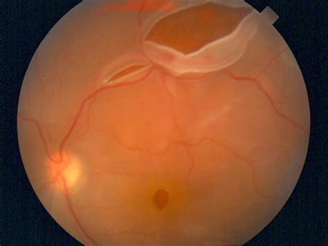 Retinal tears can develop at any age, but. Ophthalmic Consultants of Rockland - Floaters