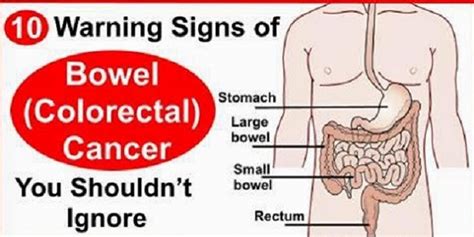 Bowel cancer symptoms symptoms of bowel cancer include: 10 Warning Signs Of Bowel (Colorectal) Cancer You Shouldn ...