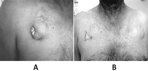 The main difference is that if. Very late pacemaker extrusion: A rare complication of ...