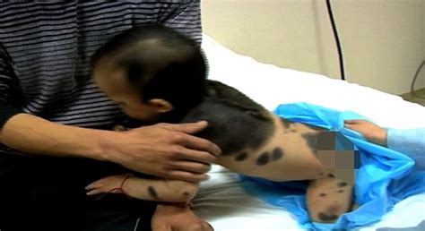 Nora was born with this cancer. doctors think a mutation spontaneously occurred in utero, causing undetected melanoma cells to grow during development. Chinese Boy has fur growing on his back due to Giant ...