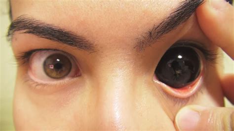 How can i get rid of a black eye asap? How to: Insert And Remove Black Sclera Contact Lenses ...