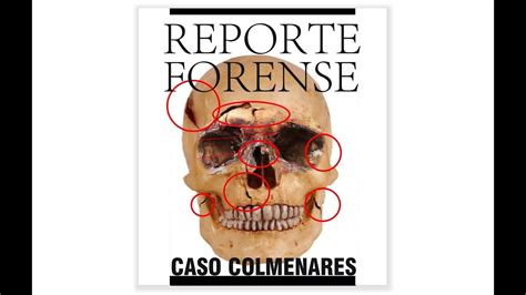 Una fotografía que capta una herida con forma de botella en el cráneo de colmenares, permite al investigador rubén darío. El Reporte Forense del Caso Colmenares - YouTube