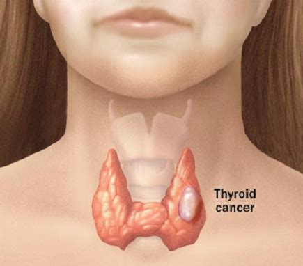 Most often, women, as well as people over 40, are exposed to. Medullary Thyroid Cancer: Symptoms, Diagnosis & Treatments ...
