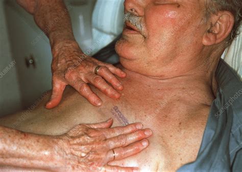 Limb sparing surgery is a procedure that replaces a diseased area of bone with a metal implant, or bone graft from another dog (allograft) , or a combination of bone graft and metal implant (allo prosthetic. Cancer pain relief - Stock Image - M725/0310 - Science ...