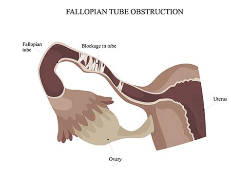 Fallopian Tube Blockage Treatment South Delhi, Fallopian Tube Treatment ...