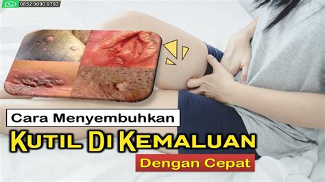 Dibawah ini adalah beberapa langkah cara menghilangkan batuk yang cepat dan aman. Cara Menyembuhkan Kutil Di Kemaluan Dengan Cepat - YouTube