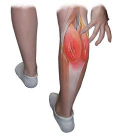 The sartorius muscle is the longest muscle in the body. Torn Calf Muscle Treatment