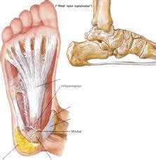 Sehnenentzündungen auf der innenseite des fußes können, je nach genauer lokalisation, unterschiedliche sehnen betreffen. Yosukeのカナダ大学院留学ブログ: 足底腱膜炎について考察①