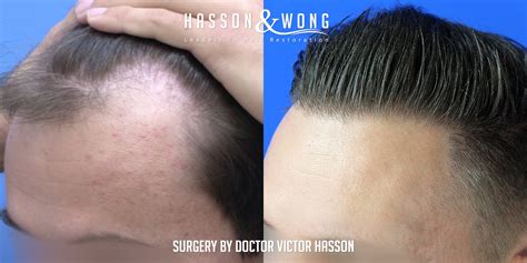 We did not find results for: FUT Hair Transplant | 4260 Graft Surgery - See His New ...