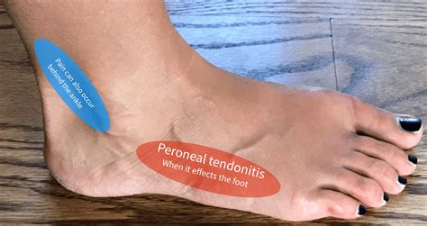 At the pain center, we can help diagnose your leg pain. What is that pain on the outside of my foot? - Almawi ...