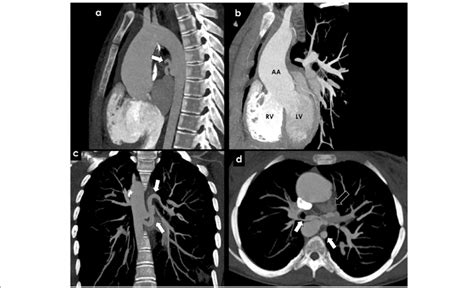 Most adults with repaired tetralogy of fallot may require another procedure or intervention during accessed april 6, 2017. Congenital causes of BAH-Tetralogy of Fallot and pulmonary ...