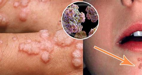 Cancerians are one of the most passionate lovers but will take their time to come out of their shells. What Is the Type of HPV That Causes Cervical Cancer?