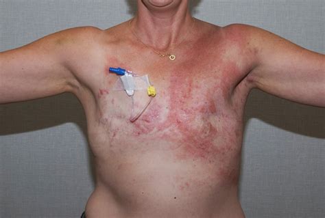 Not all the symptoms mentioned above need to be present in order to make a diagnosis of inflammatory. How Do Inflammatory Breast Cancer Symptoms Resemble ...