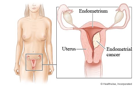 There are different types of uterine cancer. Uterine Cancer - Gynecology Cancer - Sign and Symptoms ...