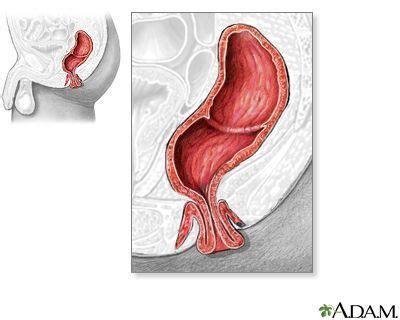 They can be harmless (benign) tumors or aggressive (malignant) tumors that spread to other parts of the body. What to Do If You Experience a Rectal Prolapse | Rectal ...