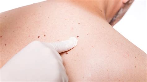 When a cancer man loves a woman, he is sometimes needy, clingy, moody, and insecure. This Man's "Skin Tag" Turned Out to Be Skin Cancer | Allure
