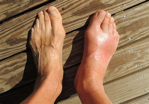 And while it may be difficult to conceal the for a long time, gout was considered a disease of the wealthy. Smartphone app could help prevent a gout attack | UNSW ...