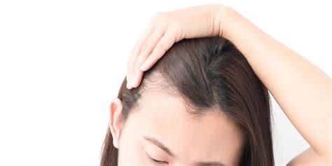 It's called androgenetic alopecia, or female (or male) pattern hair loss. Hair loss on temples: Causes and Home remedies