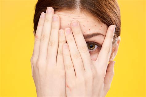 Alle infos zur hauterkrankung akne finden sie im ratgeber ihrer online die acne neonatorum kann neugeborene in den ersten wochen betreffen. Akne - das hilft gegen unreine Haut | BRIGITTE.de