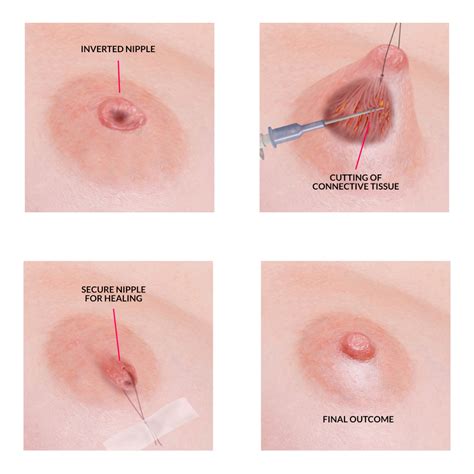 Depending on the size of the clog, you should be able to feel the hard spot soften up. Inverted Nipple Correction NZ | Nipple Reduction Surgery ...