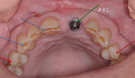 Teeth grinding in cats are a typical symptom of dehydration or acidity. Tooth Wear and Damage | Acid Erosion | Mint Hill Dentistry