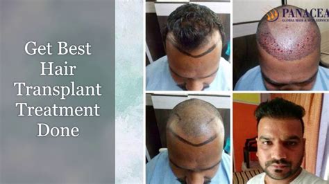 Eugenix is the largest hair transplant chain of the country and provides all kinds of hair and skin treatment. Hair Transplant Clinic in Delhi | Hair Transplant Surgeon ...