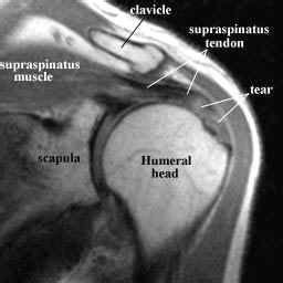 Musculotendinous anatomy of the supraspinatus. Abnormalities On Mri Of The Subscapularis Tendon In The ...