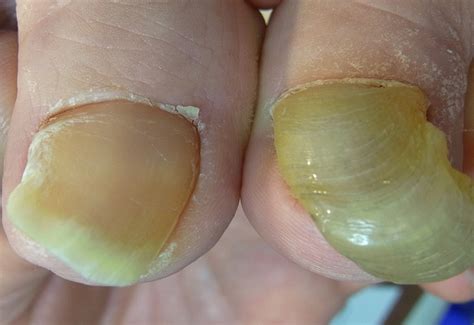 川越市で変形爪の修復、諦めるにはまだ早い可能性が|埼玉 ...