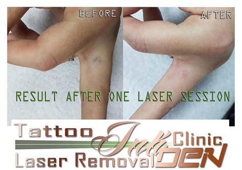 The lasering was easier than i could have ever imagined. Laser Tattoo Removal *** This is the results after just ...