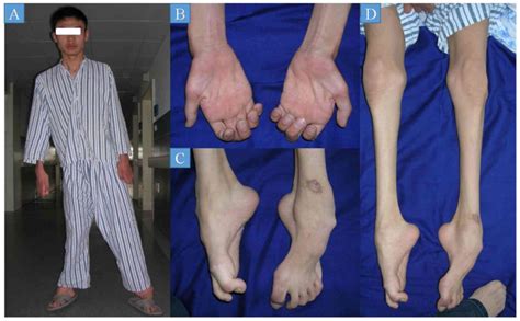 This disease is the most commonly inherited neurological disorder affecting about one in 2,500 people. Exome sequencing reveals a novel MFN2 missense mutation in ...