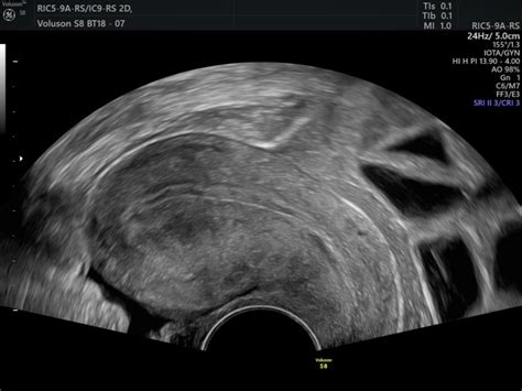 A pelvic ultrasound scan is used to assess organs and structures including the uterus, cervix and ovaries within the female pelvis. Gynaecological Pelvic Scan | Private One-On-One Pregnancy ...