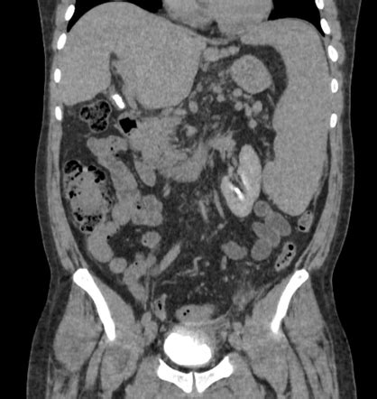 The ct renal 4 phase shows a lobulated enhancing mass at interpole of right kidney measuring 8.8 x 6.6 x 8.6cm. Image | Radiopaedia.org