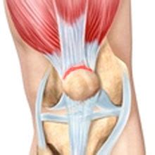 Treatment for quadriceps tendinitis involves resting and icing the joint, avoiding. Quadriceps Tendinopathy / Tendonitis Knee Pain