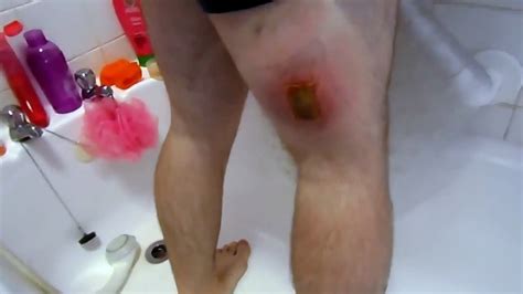 Are you struggling with finding an ingrown hair treatment for legs? Biggest Ingrown Pubic Hair | Ingrown Hair