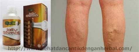 Obat Yang Ampuh Untuk Mengatasi Varises Di Kaki - Hidup ...