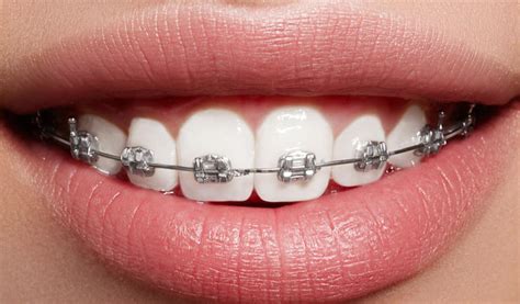 Maybe you would like to learn more about one of these? Hukum Menanggalkan 'Braces' dan Gigi Palsu Dari Jenazah ...