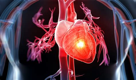 Alendronate May Reduce Risk for CV Events After Hip ...