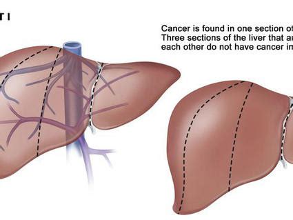 Research shows that treatment can reduce the risk of liver cancer. Children with ALL Can Skip Brain Radiation - National ...