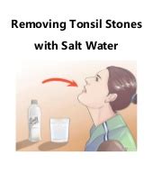 If you took the water out of salt water, would it just leave salt? Five Simple Steps to Treat the Swollen Tonsils