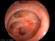 La dieta cambia se i diverticoli si infiammano? Diverticolosi del colon | Clinica Città di Parma