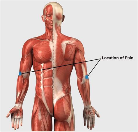 Corticosteroid shots are only considered if several weeks of rest and. Tennis Elbow Injury Protocol - Rock Rehab Pyramid for Rock ...