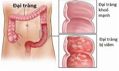 Chân thành cảm ơn các đơn vị liên kết, quý đại lý vé số từng khu vực, đặc biệt là các đại lý ở các tỉnh vùng xa đã liên kết hỗ trợ nhiệt tình trong suốt quá trình từ những ngày đầu hết sức khó khăn. Đại tràng nằm ở đâu, viêm đại tràng đau ở đâu? Góc giải đáp