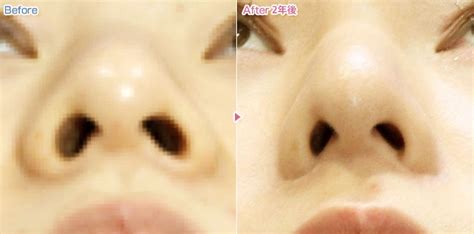鼻先を細くまたは高く 症例写真1｜あつぎ美容クリニック