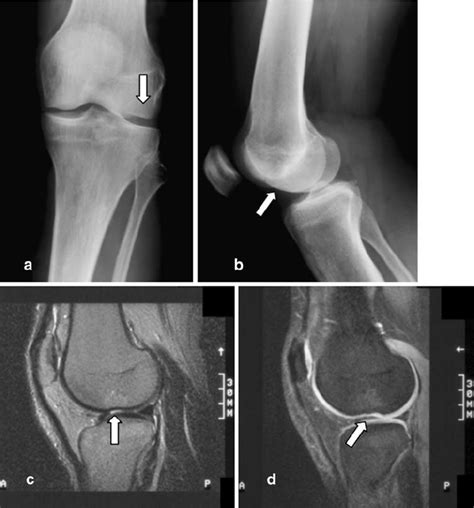 Meniscal injuries occur in up to 50% of all condylar. Three-month-old transchondral fracture on both radiographs ...