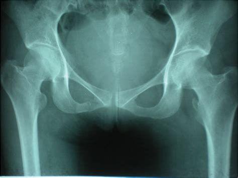 Avulsion fractures result when the fracture fragment is pulled from its parent bone by forceful contraction of a tendon or ligament. Article Fulle Text