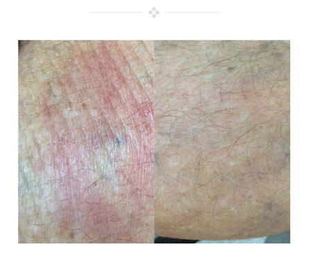 This happens because the blood leaks out and has nowhere else to go. Physicians Agree That Using Dermaka Cream Reduces Redness ...